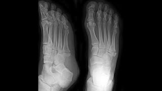 5th Metatarsal Base Fracture Foot [upl. by Ardnuahc527]