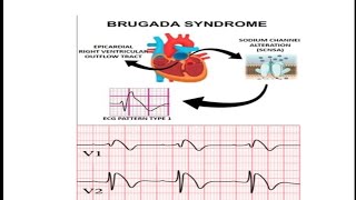 Brugada Syndrome  ECG Changes in Brugada Syndrome  Brugada Sign  Symptom and Signs in Brugada [upl. by Jaimie201]