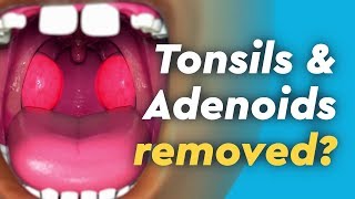 Tonsils and Adenoids Surgery [upl. by Hoskinson863]