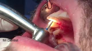 Preparation For A Crown On A Frontal Tooth  Upper Canine Preparation [upl. by Auod343]