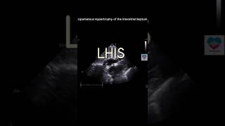 Lipomatous Hypertrophy of Interatrial Septum echocardiography 심장초음파 heart sonography tte [upl. by Hokanson]