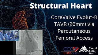 CoreValve EvolutR TAVR 26mm via Percutaneous Femoral Access  August 2015 Structural Live Case [upl. by Emelita151]