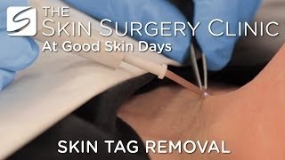 Skin Tag Removal  Watch the Procedure [upl. by Hillegass]