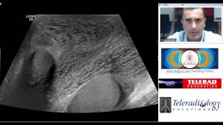 Fournier Gangrene Diagnosis teaching by Dr Arjun Kalyanpur [upl. by Lough]