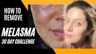 Melasma Removal at Home I Melasma Remove cream I Melasma Skin Care Regimen Routine [upl. by Teiv]