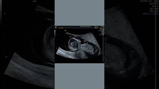 Plecenta baby  womb scan baby size moment [upl. by Ysus707]