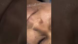 Dermapen treatment [upl. by Hanauq]