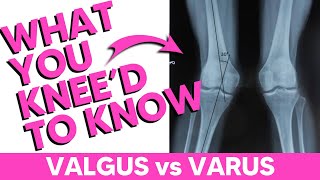 Valgus vs Varus The Best Mnemonic [upl. by Trent]