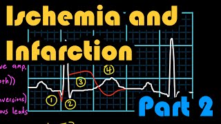 Ischemia Infarction and the Waveforms Q through U Part 2 How to Read an EKG Curriculum [upl. by Eicrad]