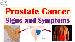 Prostate Cancer Signs and Symptoms Urinary Sexual amp Metastatic Symptoms [upl. by Lednahs]