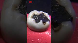 Restauración dental satisfying [upl. by England972]