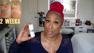 Hyperpigmentation  Dark Spots  Almost Gone WOW [upl. by Spatola]