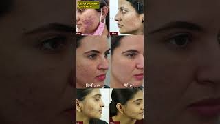 Powerful Acne Treatment for Acne [upl. by Lrig187]