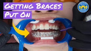 Process of Getting Braces [upl. by Nahgen57]