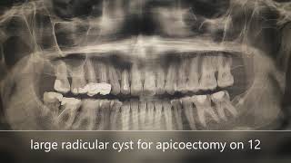 Apicoectomy of fluctuant radicular cyst of 12 [upl. by Asylem]