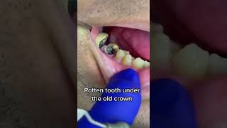 Wisdom Tooth Extraction  Tooth Decay Treatment [upl. by Izawa318]