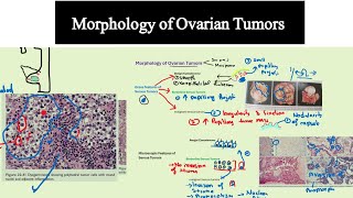 Morphology of Ovarian Tumors Special Pathology DrMUsman [upl. by Frederique]