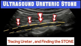 URETERIC CALCULUS  Ultrasound Tracing And Finding URETERIC STONE [upl. by Read]