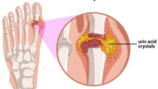 Gout ArthritisDefinitionPathophysiology Clinical manifestationsRisks Factors Treatment Hindi [upl. by Eissirc225]