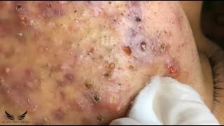 Blackhead Whitehead Removal  Cystic Acne Treatment  Elderly Pimple Popping  Facial Acne Spa 082 [upl. by Danais470]