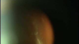 Eye Floaters Scott Geller MD Fort Myers Florida [upl. by Ahsimrac]