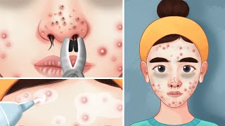 ASMR Acne Removal Skin Care animationFull Blackhead Treatmentnose hair removal [upl. by Alaster]