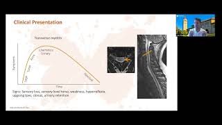 Diagnosis of Multiple Sclerosis [upl. by Canning824]