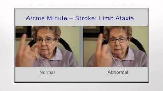 Stroke limb ataxia [upl. by Ilse312]