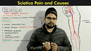 Sciatica Symptoms Causes and Treatments of Sciatic nerve [upl. by Sherrie323]