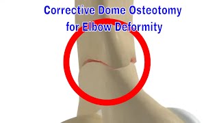 Corrective Dome Osteotomy for Cubitus Varus and Valgus Deformity [upl. by Shaefer]