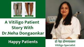 A Vitiligo Patient Story With DrNeha Dongaonkar  vitiligo skin disease treatment [upl. by Limay]