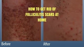 HOW TO GET RID OF FOLLICULITIS SCARS AT HOME [upl. by Graves]