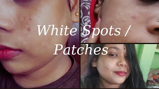 REDUCE WHITE SPOTS PATCHES IN 1 WEEK  1 सप्ताह में सफ़ेद दाग कम करें whitespots vitiligo [upl. by Enilekcaj]