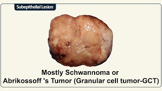 Mostly Schwannoma or Abrikossoff s Tumor Granular cell tumorGCT [upl. by Arakawa787]