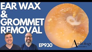 PLASTIC TUBE STUCK IN EAR CANAL  EAR WAX REMOVAL  EP930 [upl. by Meadow34]