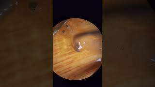 Tiny shrimp parasite removed [upl. by Aehsrop]