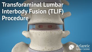 Transforaminal Lumbar Interbody FusionTLIF Procedure [upl. by Ahsircal15]