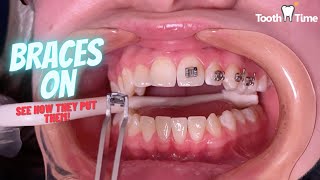 How do they put braces on  Tooth Time Family Dentistry New Braunfels [upl. by Ellinger]