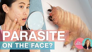 Parasites on the Face  Dr J9 Live [upl. by Adnola]