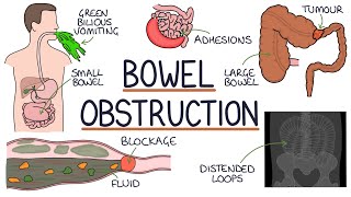 Understanding Bowel Obstruction [upl. by Eeram]