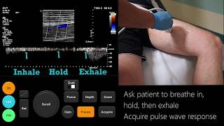 Stroke Lobar haemorrhage  radiology video tutorial MRI CT [upl. by Kahn]