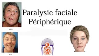 paralysie faciale périphérique  part 1 [upl. by Vallery]