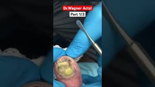 DRAINAGE OF HUGE ABSCESS🤯Part 13shorts [upl. by Arres]