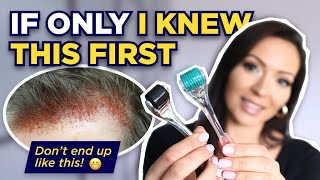 The Dermaroller Watch This BEFORE Microneedling What I wish I knew Before I Started Dermarolling [upl. by Queston]