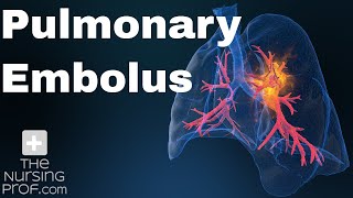 Pulmonary Embolus Nursing Care [upl. by Ollopa]