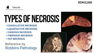 Necrosis  Types of Necrosis  Coagulative  Liquefactive  caseous  Fat  Fibrinoid  KTC MBBS [upl. by Dominus]