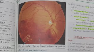 Branch Retinal Vein Occlusion  EYE [upl. by Biondo]