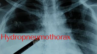 hydropneumothorax [upl. by Phippen]