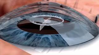 Watch live surgery using the laser cataract system  how does it work Eye News TV [upl. by Damita511]