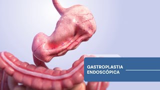 Nuevo tratamiento no invasivo para el descenso de peso Gastroplastia endoscópica en manga 🏥👨🏻‍⚕️ [upl. by Kenta]